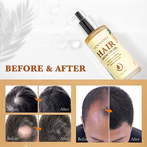 Venanoci Hair Growth Oil – Effective For Hair Growth, Hair Loss Liquid, Hair Growth Formula, Hair Care Serum, For Thicker & Healthier Hair, Reduces Hair Shedding & Thinning | The Storepaperoomates Retail Market - Fast Affordable Shopping