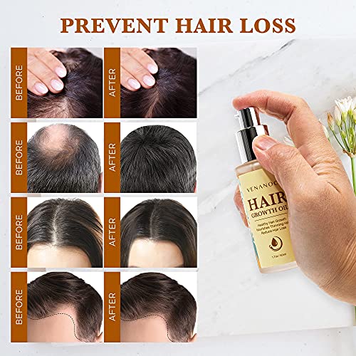 Venanoci Hair Growth Oil – Effective For Hair Growth, Hair Loss Liquid, Hair Growth Formula, Hair Care Serum, For Thicker & Healthier Hair, Reduces Hair Shedding & Thinning | The Storepaperoomates Retail Market - Fast Affordable Shopping